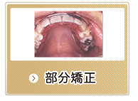 部分矯正