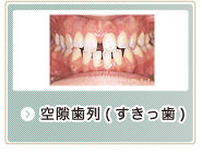 空隙歯列