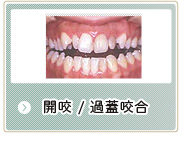 開咬、過蓋咬合