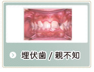 埋伏歯、親不知