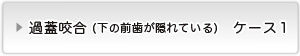 過蓋咬合ケース１