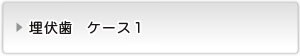 埋伏歯ケース１