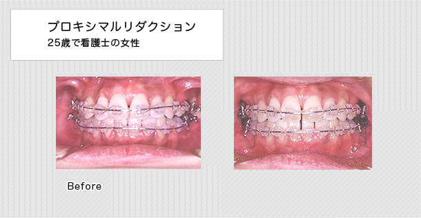 前歯の歯茎と歯の間に出来る三角の黒い隙間