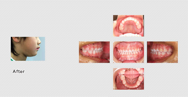 乳歯の歯並び治療