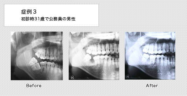 部分矯正　ケース３