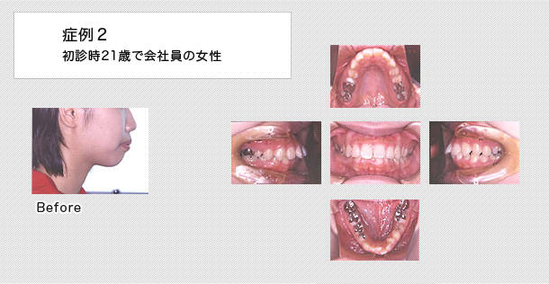 出っ歯　ケース２