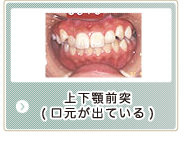 上下顎前突（口元が出ている）