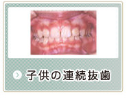 子供の連続抜歯
