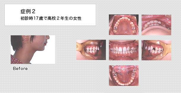 先天性欠如　ケース２