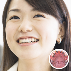 見えにくい（舌側）矯正治療