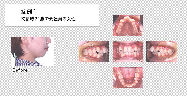 上顎前突症例　21歳会社員の女性