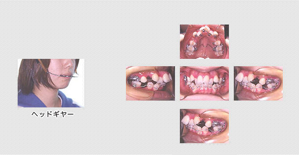 出っ歯の舌側矯正