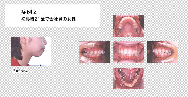 上顎前突症例　21歳女性
