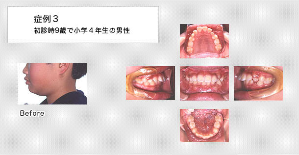 上顎前突症例　9歳の男の子