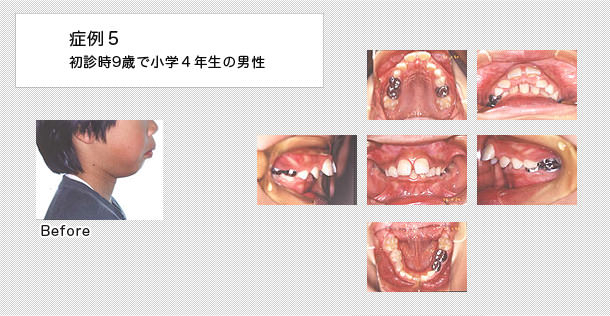上顎前突症例　9歳で小学校4年生の男の子