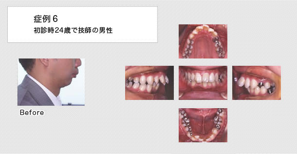 上顎前突症例　24歳の男性