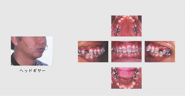 抜歯　表側の矯正