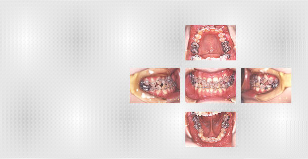 術前矯正の様子