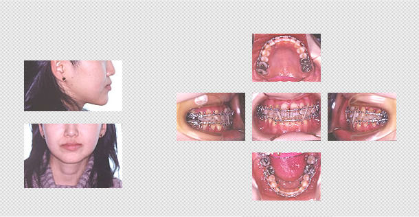 術後矯正治療中の様子