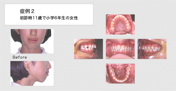11歳で小学6年生の女の子の症例