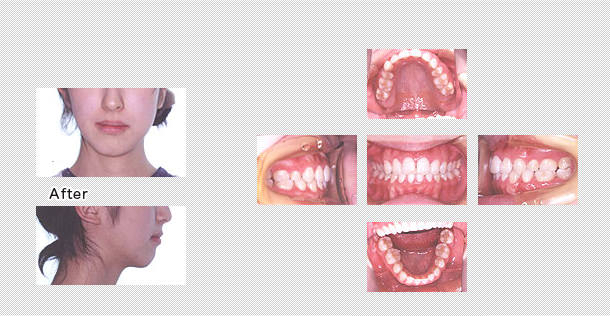 キレイな歯並びに