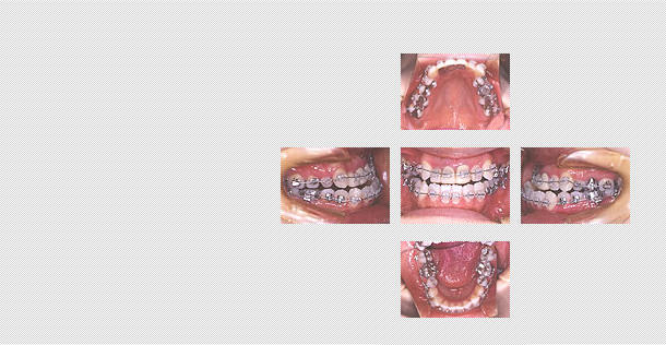 差し歯の矯正