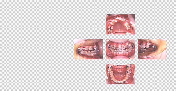 矯正治療途中経過
