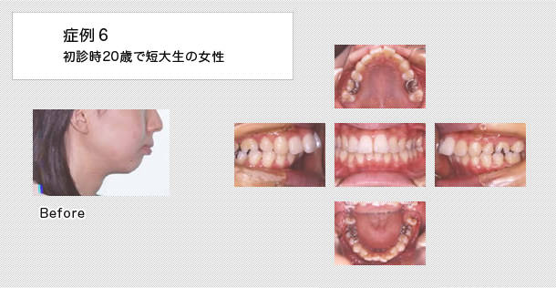 20歳で短大生の女性の症例