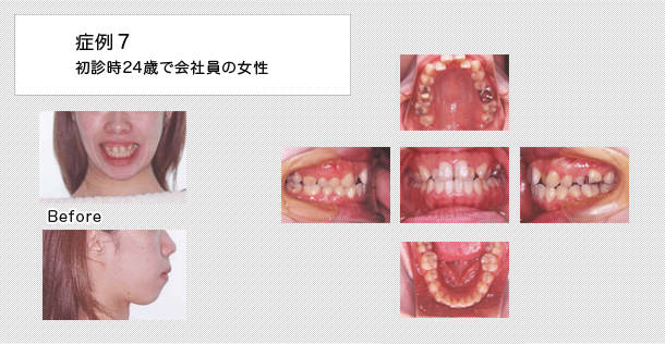 24歳で会社員の女性の症例