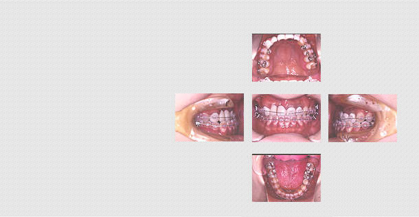 術前矯正の様子
