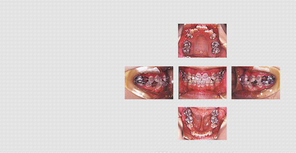 抜歯後の矯正