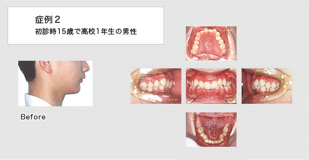 15歳で高校1年生の男子の症例
