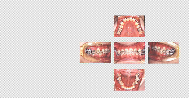 下の歯並びにも矯正装置を装着