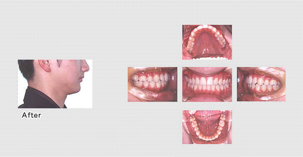 安定した歯並び