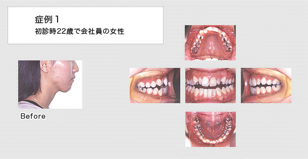開咬・顎関節症の治療と症例｜恵佑会矯正歯科クリニック