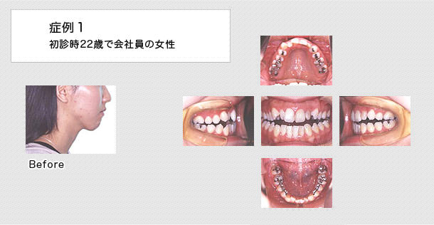 22歳で会社員の女性の症例