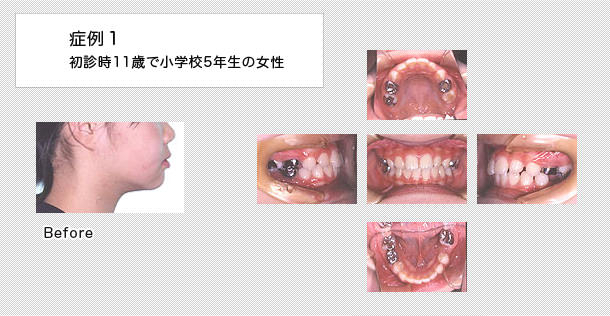 11歳で小学5年生の女の子の症例