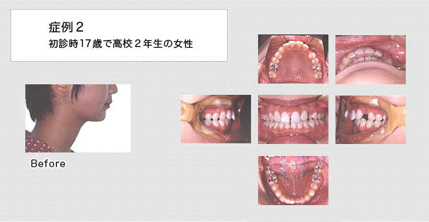 17歳で高校2年生の女の子の症例