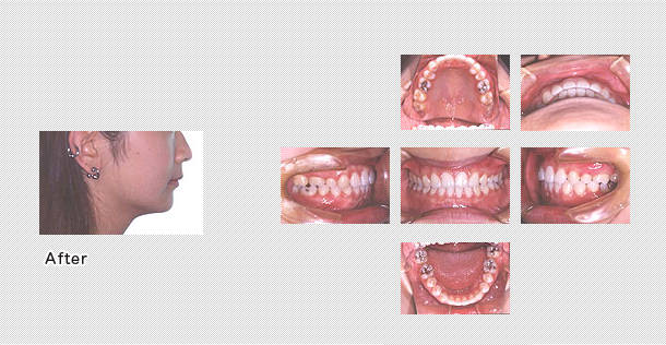 上下の前歯のかみ合わせが良くなりました