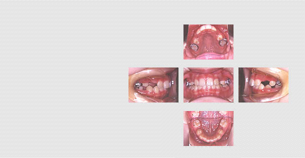 乳歯の奥歯の抜歯