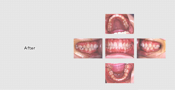 永久歯の歯並び