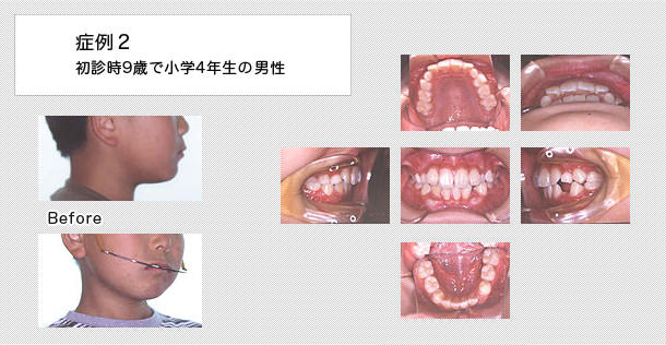 連続抜歯症例　9歳で小学校4年生