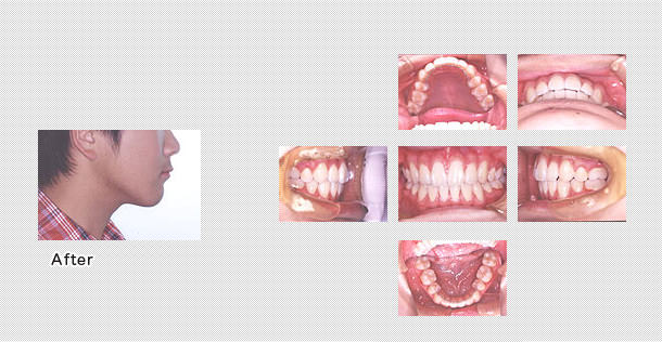 治療後の歯並び