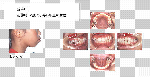 12歳で小学6年生の女の子の症例