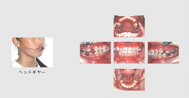 重症な上下顎前突の治療