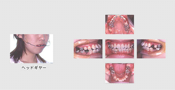上の歯並びに裏側の矯正