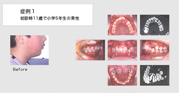 11歳で小学5年生の男の子の症例