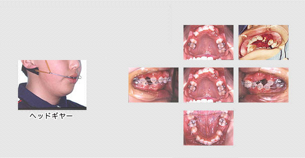 手術後に矯正治療