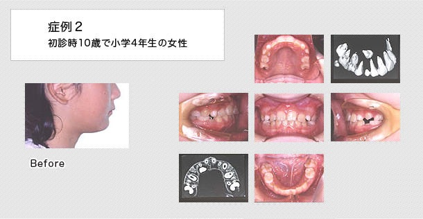10歳で小学4年生の女の子の症例