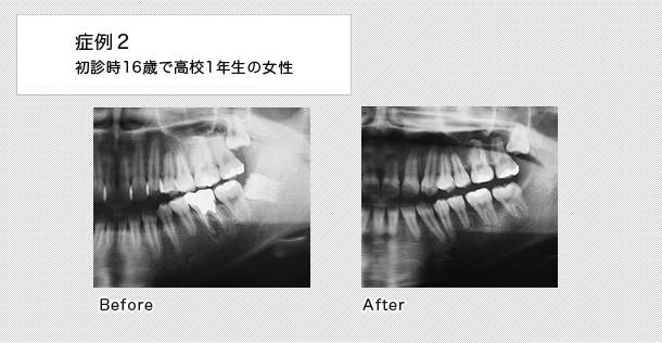 16歳で高校1年生の女性の症例